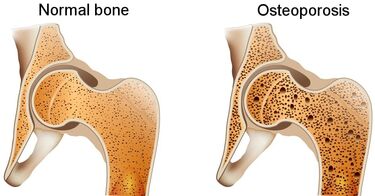 Normal vs osteoporotic bone