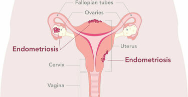 Diagram showing endometriosis and the uterus