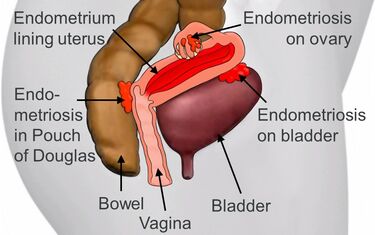 Common sites of endometriosis