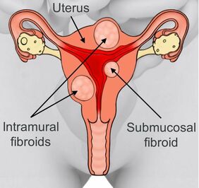 Diagram of a uterus with different types of fibroids