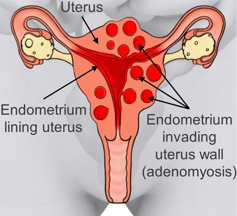 Picture of a uterus affected by adenomyosis