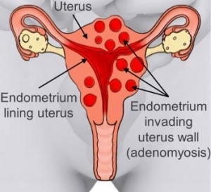 Picture of a uterus affected by adenomyosis