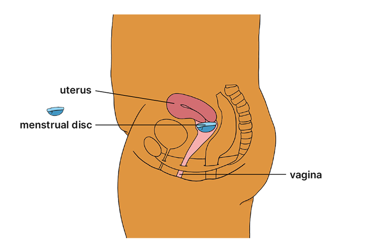 Menstrual disc diagram